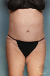 Liposuction Case 51 After